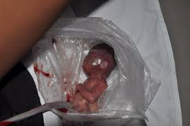 abortionpic1